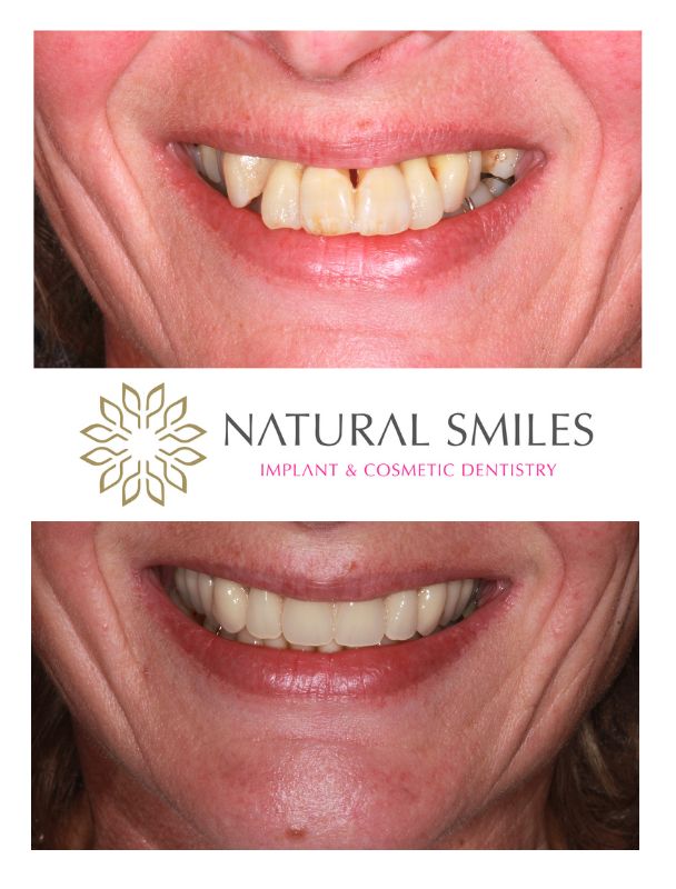 All on 4 Cosmetic Dentist Leicester