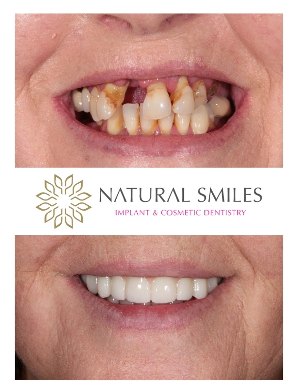 All on 4 Dental implants Leicester