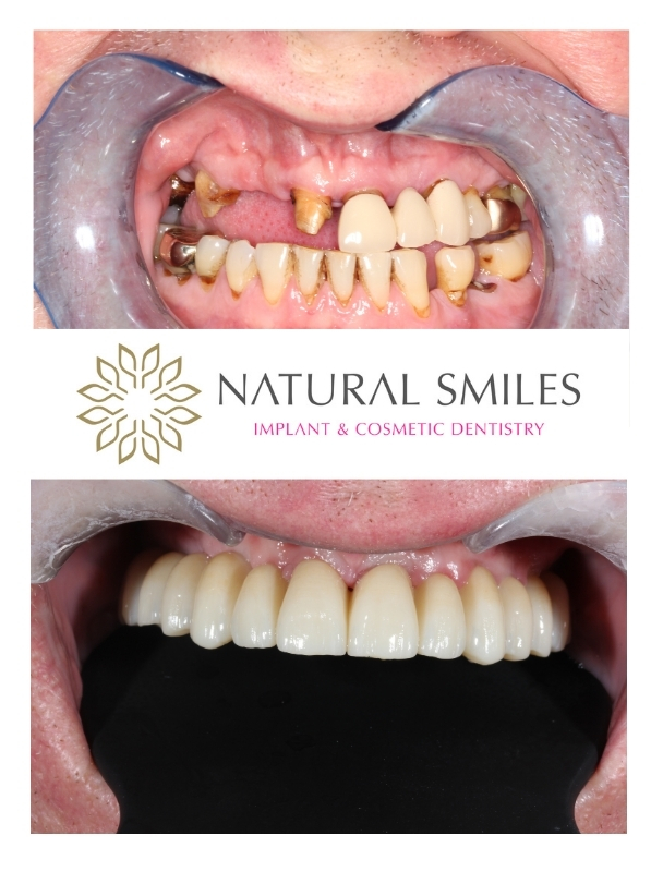 All on 4 Implants Leicester and Corby 1 Retracted