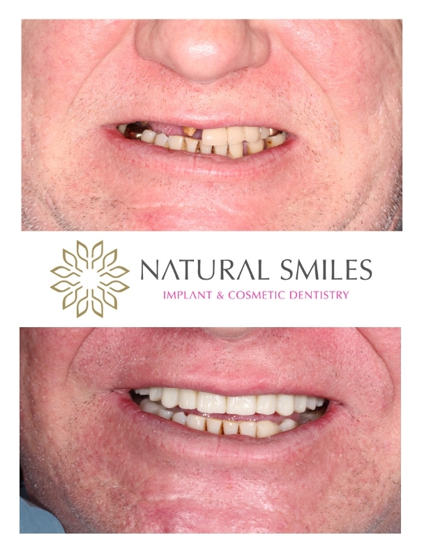 All on 4 Implants Leicester and Corby 1 Smile