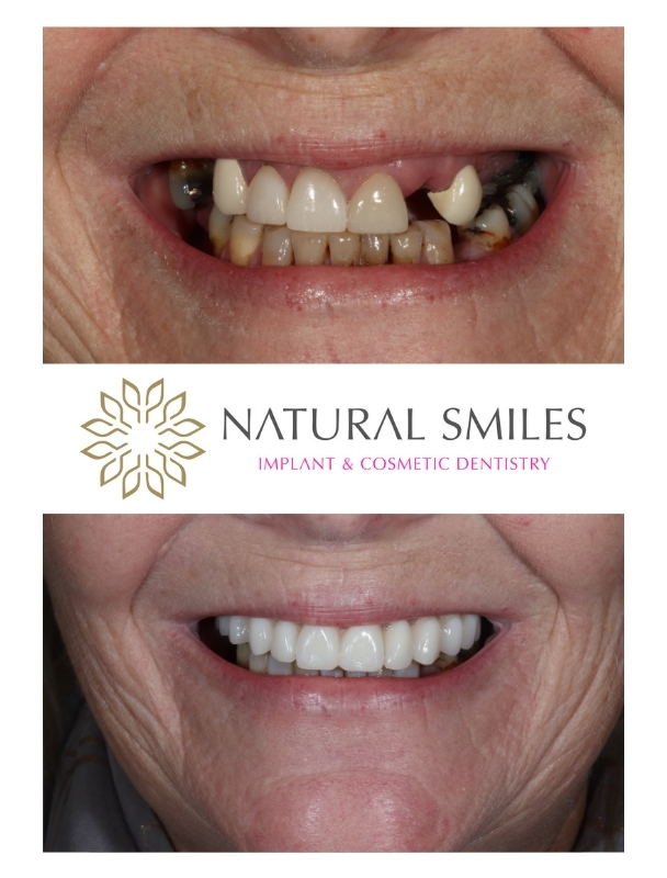 All on 4 dental implants Leicester and Corby LB1