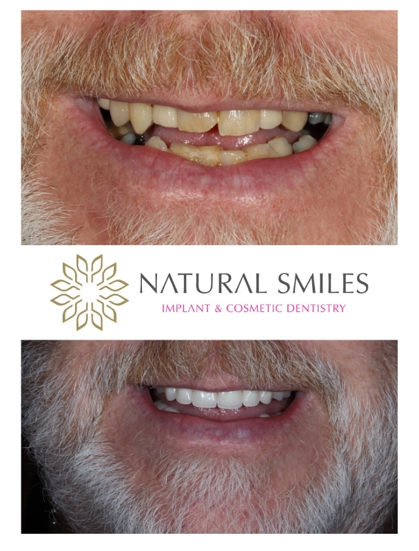 All on 4 dental implants Leicester and Corby SK