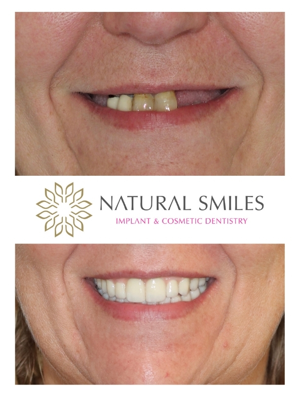 All on 4 dental implants Leicester and Corby VD1