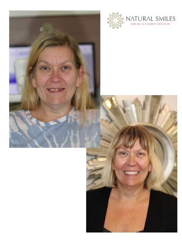 All on 4 dental implants Leicester and Corby VD1a