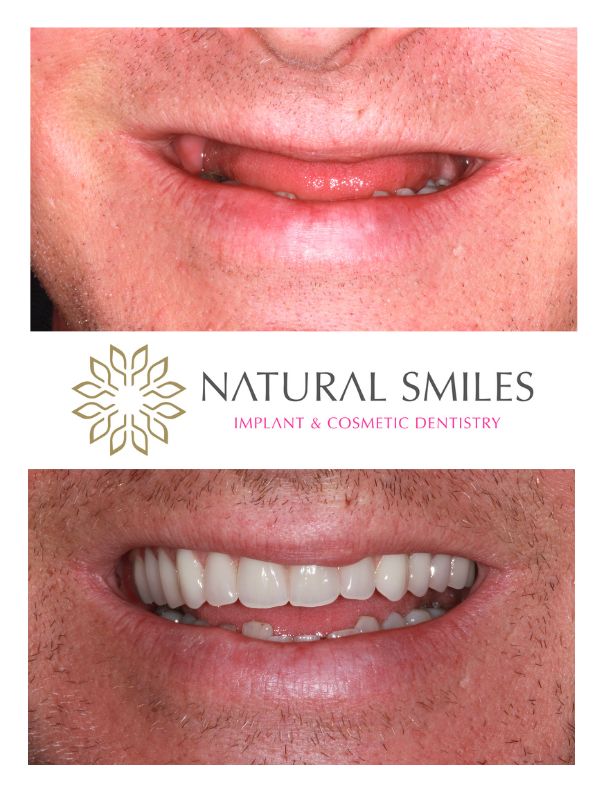 All on 4 dental implants Leicester and Corby, upper teeth