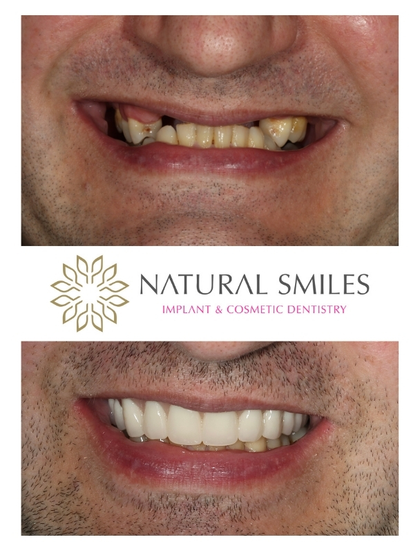All on 4 dental implants Leicester and Corby upper