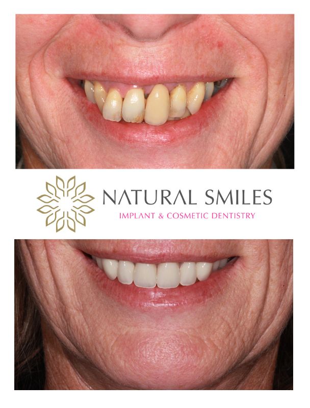 All on 4 dental implants Leicester fixed teeth in a day