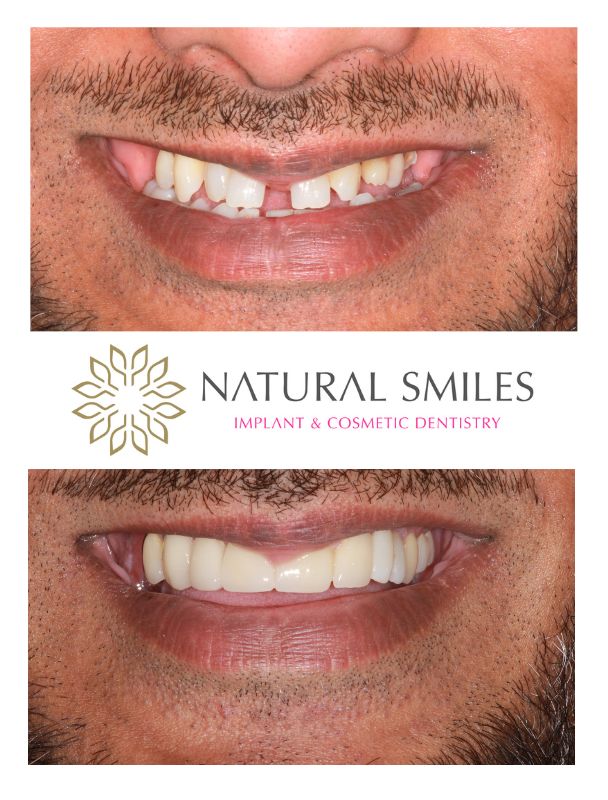 Cosmetic Dentistry Dental implants Veneers Leicester and Corby
