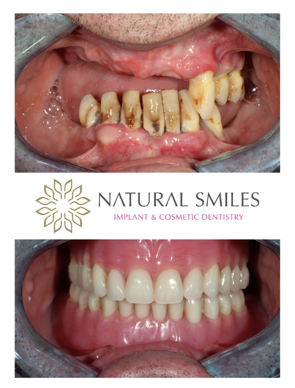 Dental implant Dentures Leicester and Corby