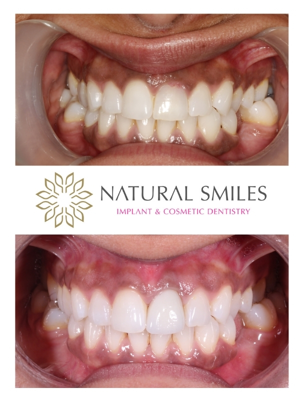 Dental implant Leicester front tooth