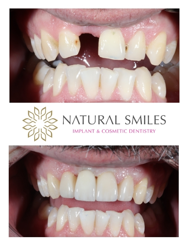 Dental implant and Porcelain Veneer Leicester and Corby retracted