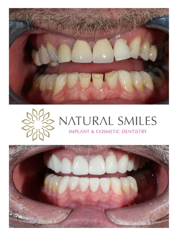 Dental implant and Veneers Corby and Leicester 1a