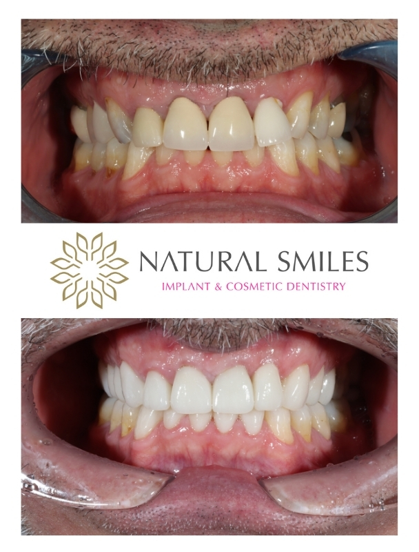 Dental implant and Veneers Corby and Leicester 1b