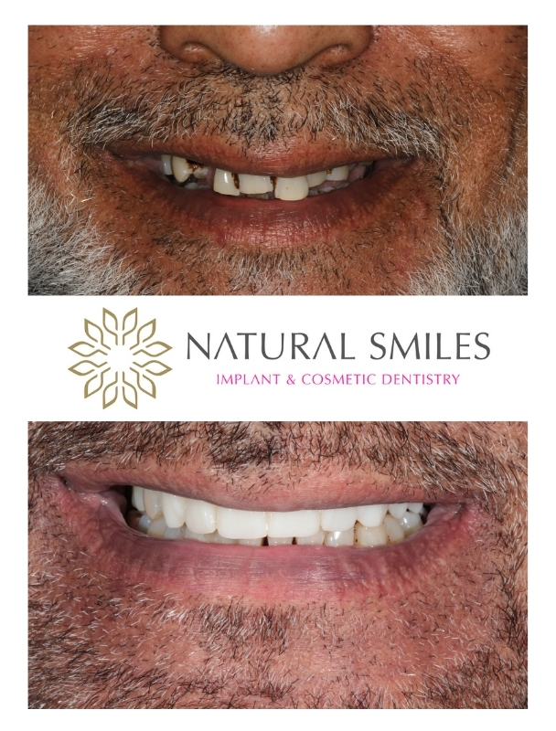 Dental implants All on 4 Corby and Leicester 3