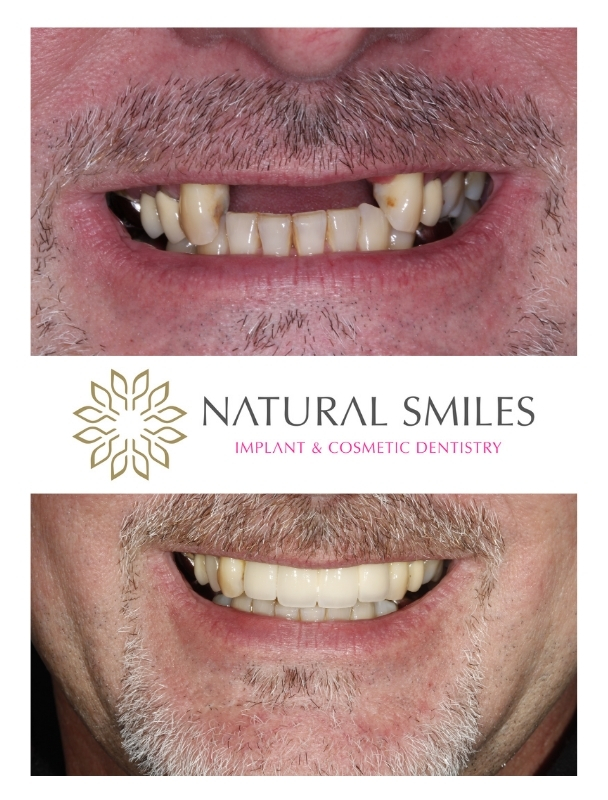 Dental implants Corby and Leicester front teeth 2