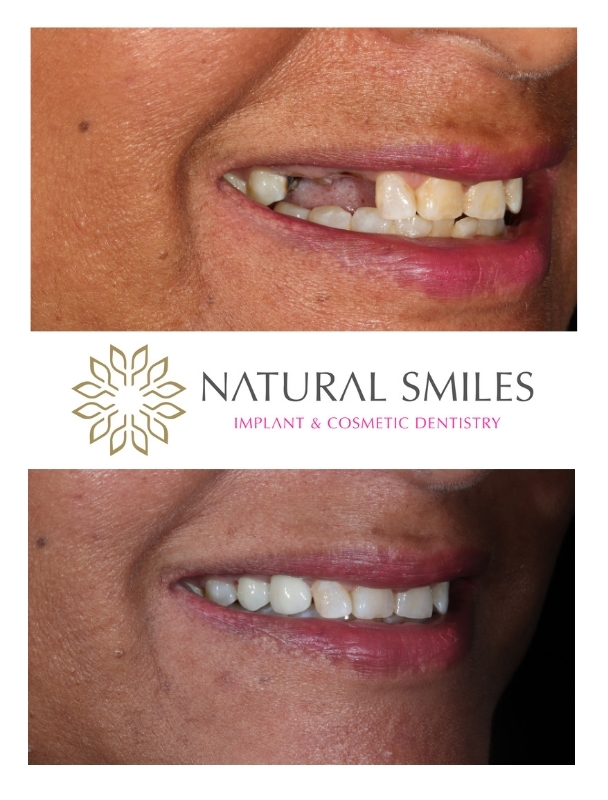 Dental implants Leicester 1