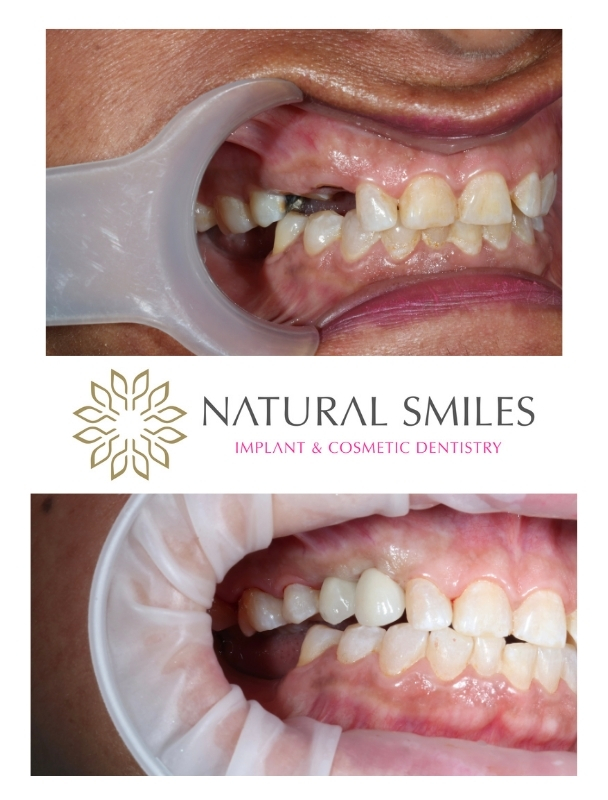 Dental implants Leicester retracted