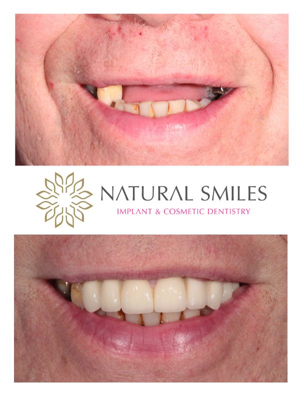Dental implants Leicester upper teeth