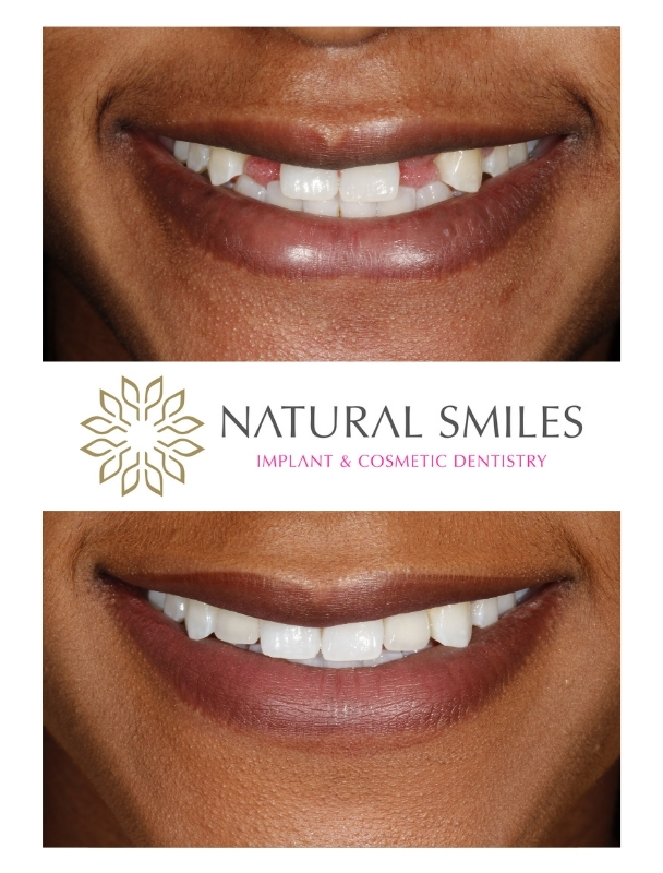 Dental implants Missing laterals Leicester and Corby