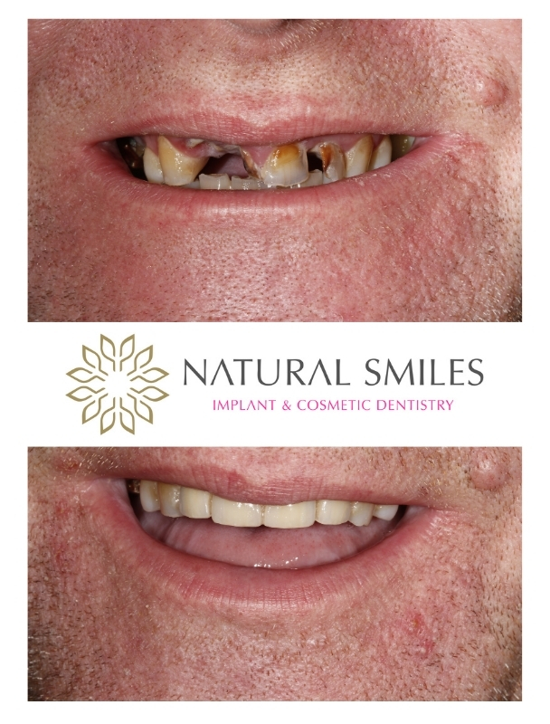 Dental implants front teeth Leicester and Corby