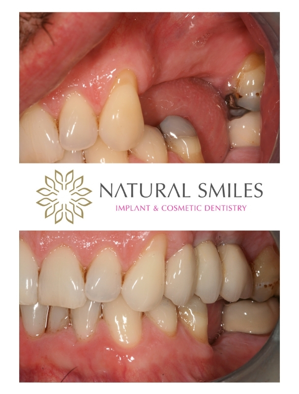 Dental implants upper Leicester and Corby