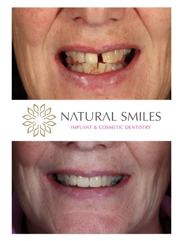 Front teeth Dental implants Leicester and Corby 1c